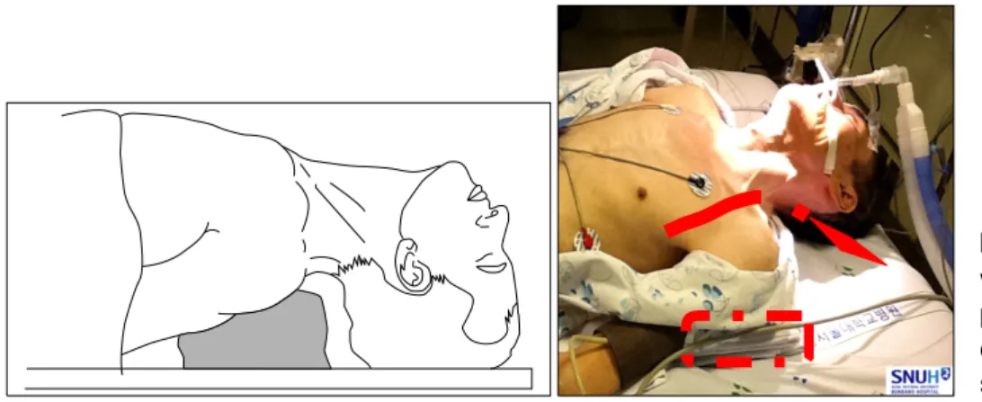 Figure  5.  Look  of  patient  with  neck  extension.   Ada-pted  from  Kim  KH.   Trach-eostomy