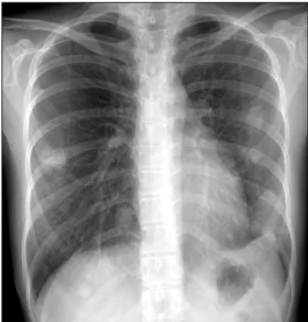 Figure  1.  Chest  radiography  shows  multiple  nodular  opacities  of  varying  size  in  both  lungs.