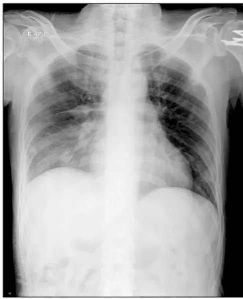 Figure  1.  Chest  X-ray  showed  right  lower  zone  con- con-solidation  with  pleural  effusion  and  peripherally  multiple  nodular  opacities.