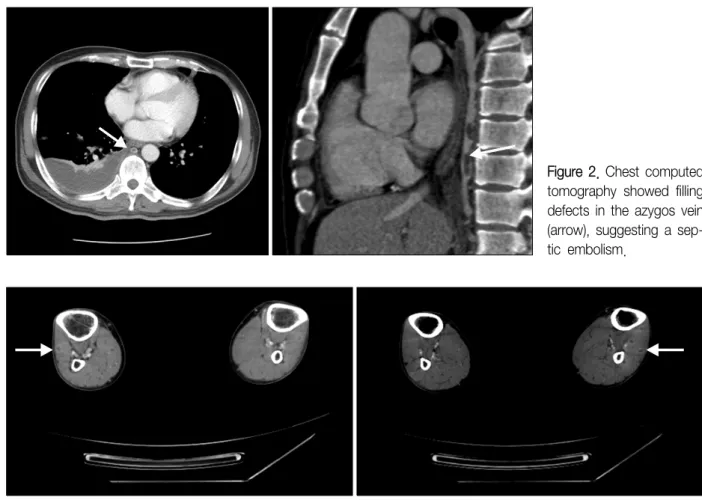 Figure  3.  Long  vascular  computed  tomography  showed  lower  leg  intramuscular  abscess.