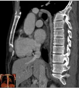 Figure  4.  Follow-up  of  chest  computed  tomography  re- re-vealed complete resolution of the septic embolism in the azygos  vein.
