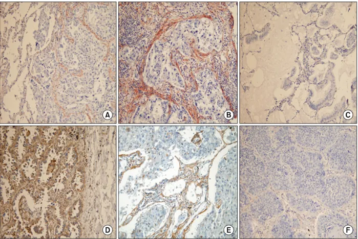 Figure 1. Periostin expression in tumors and intratumoral stroma (immunostain, ×200). (A) Non-neoplastic lung stroma shows negative (right) immunostaining in contrast to neoplastic stroma (left)