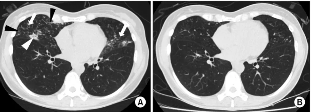 Figure  1.  A  45-year-old  woman  with  bronchiectasis  and  nontuberculous  mycobacterial  lung  disease  caused  by  Mycobacterium  terrae