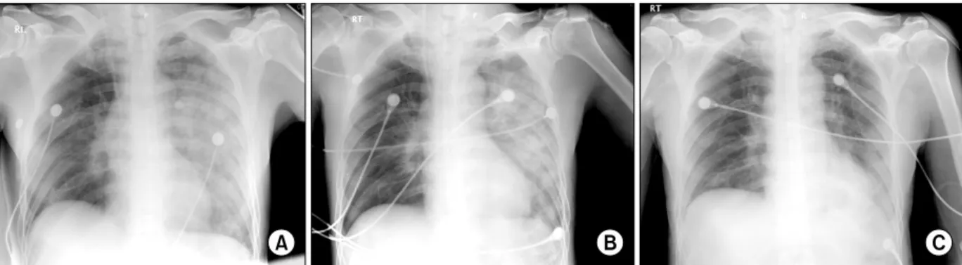 Figure  1.  Serial  change  of  patient's  chest  radiogram.  (A)  Initial  x-ray  in  the  emergency  room  shows  an  infiltration  in left lung, right upper lung and right lower lung