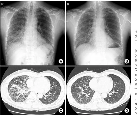 Figure  1.  (A)  The  initial  chest X-ray shows multiple  miliary  nodular  lesions  in  the  lower  right  lung  fields