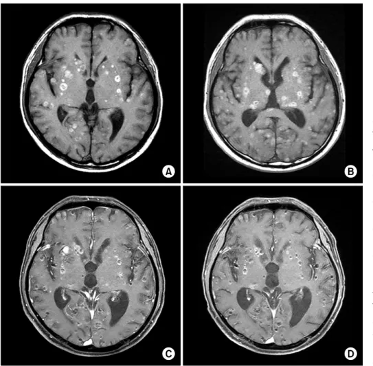 Figure  2.  (A)  The  initial  brain  MRI  of  an  outside  hospital shows multiple  cy-stic  lesions  with  tiny   scat-tered  calcified  nodules
