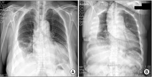 Figure 2. Initial chest X-ray shows right pleural effusion (A) and shifting of the right pleural  effusion in the right  decubitus  view  (B)