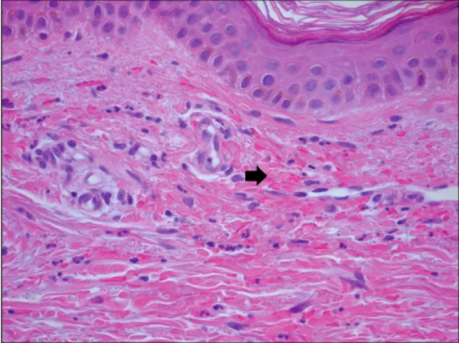 Figure 3. Contrast enhanced CT scan shows right pleural effusion  and  parietal  pleural  thickening