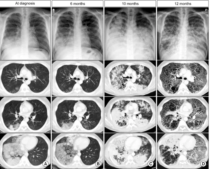 Figure  1.  Serial  CXR  and  CT  images.  (A)  Initial  CXR  and  CT  show  ground-glass  opacities  (GGOs)  and  consolidations in  the  right  lower  lobe  as  well  as  ill-defined,  centrilobular  nodules  in  both  lungs