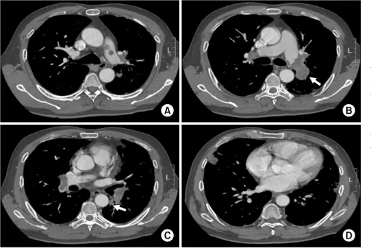 Figure  2.  Axial  enhanced  CT  scans  obtained  with  pulmonary  embolism   pro-tocol showed multifocal low attenuating  filling  defects  within the proximal left  pul-monary  artery  (A),  distal  right and left pulmonary  teries,  left  lower  lobar  
