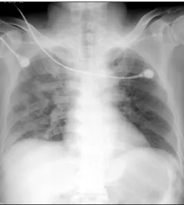 Figure  3.  Chest  CT  scan  two  months  later  shows  dis- dis-appeared filling defects in pulmonary artery of right lower lung  (arrow)