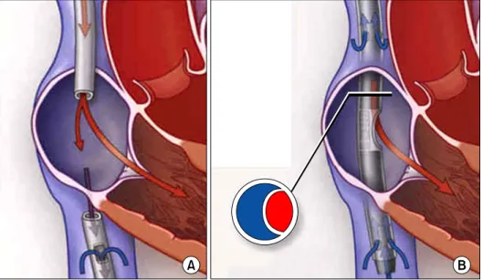Figure  1.  (A)  Recirculation  phenomenon.  (B)   Dual-lu-men  cannula.  This  figure  was  reprinted  from  NEJM  2011:365:1905-14.
