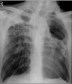 Figure 1. The initial chest X-ray showing destroyed lung lesions.  Multifocal  cystic  lesions  and  consolidations  are  also  seen.