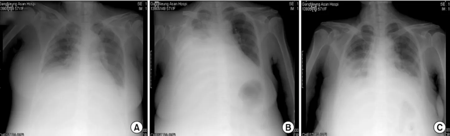 Figure  1.  (A)  Chest  X-ray  study  before  thoracentesis.  (B)  Large  amount  of  pleural  effusion  occurred  after  thoracentesis  due  to  iatrogenic  hemothorax