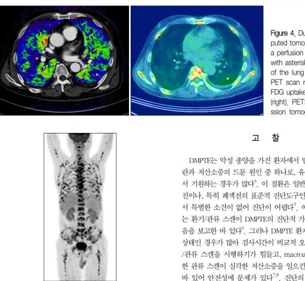 Figure 5. 18-FDG PET indicated a hypermetabolic lesion in  the  bone  marrow.