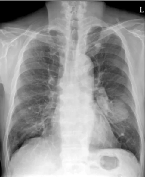 Figure 1. The initial chest X-ray revealed a 6×5.2 cm size mass  in  the  left  lower  lobe.