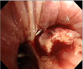 Figure 4. Bronchoscopy revealed a polypoid mass-like le- le-sion  at  the  superior  segment  of  the  left  lower  lobe.