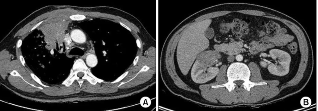 Figure 2. (A) Chest computed tomography revealed a low attenuation lesion communicating with the right anterior chest wall, suggestive of empyema necessitatis formation