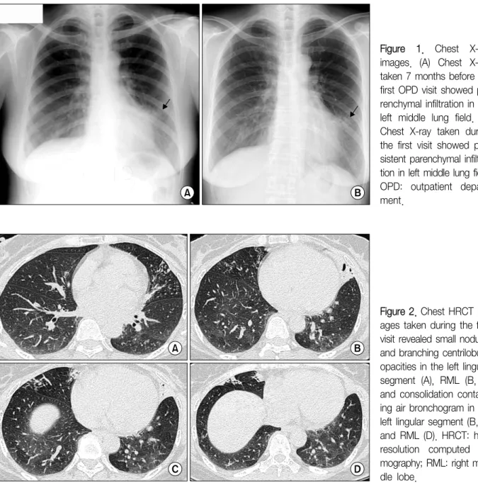 Figure  1.  Chest  X-ray  images.  (A)  Chest  X-ray  taken 7 months before the first OPD  visit  showed   pa-renchymal infiltration in the  left  middle  lung  field