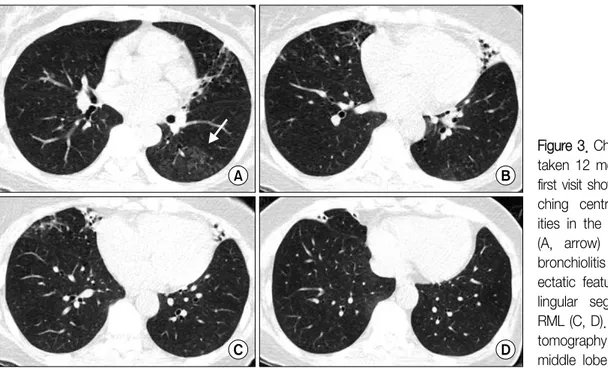 Figure 3. Chest CT images  taken  12  months  after  the  first visit showed new  bran-ching  centrilobular   opac-ities  in  the  left  lower  lobe  (A,  arrow)  and  persitent  bronchiolitis  and   bronchi-ectatic  features  in  the  left  lingular  segm
