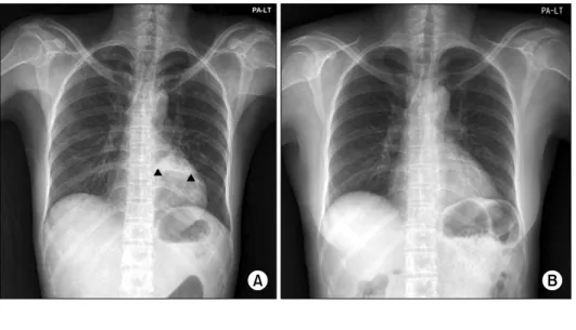 Figure  2.  (A)  Abdominal  contrast  enhanced  CT  images  showed  an  approximately  4.5  cm  size  mass  (black  arrow)  in the  central  liver