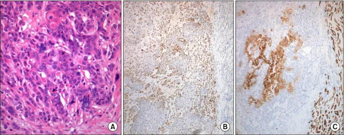 Figure 3. The metastatic renal tumor shows a poorly differentiated carcinoma with squamoid differentiation (A, hematox- hematox-ylin  and  eosin,  ×200)