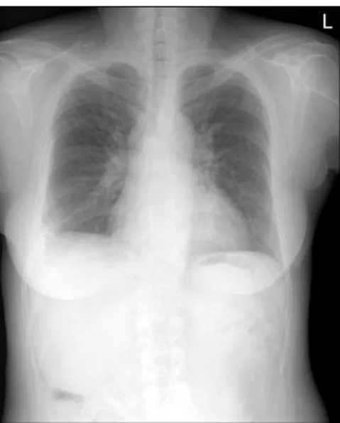 Figure  5.  Simple  chest  radiography  after  treatment  with  systemic corticosteroid and MTX