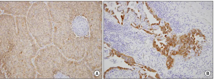 Table 1. Relationship between human papillomavirus (HPV) 16/18 E6 oncoprotein expression and clinicopathological variables