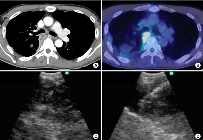 Figure  1.  (A)  Contrast-enhanced  CT  of  the  chest  showing  the  pleural  mass  adjacent  to  the  right  main  bronchus