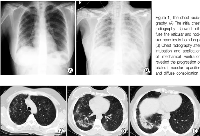 Figure  1.  The  chest  radio- radio-graphy. (A) The initial chest radiography  showed   dif-fuse fine reticular and  nod-ular opacities in both lungs.