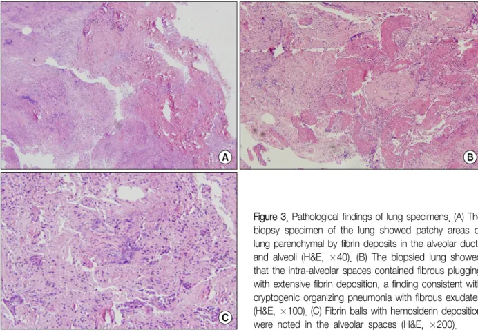 Figure 3. Pathological findings of lung specimens. (A) The  biopsy  specimen  of  the  lung  showed  patchy  areas  of  lung parenchymal by fibrin deposits in the alveolar ducts  and  alveoli  (H&amp;E,  ×40)