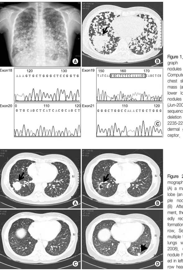 Figure  2.  Computed  to- to-mography  of  chest  shows  (A)  a  mass  in  right  lower  lobe  (an  arrow)  and   multi-ple  nodules  (May-2008)