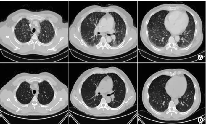 Figure  3.  (A)  Chest  computed  tomography  scan  shows  multiple  5∼10  mm  sized  nodules  with  ground  glass  opacities scatterd in both lung fields