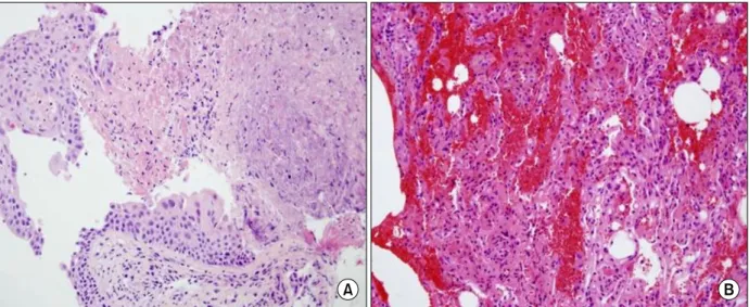 Figure  5.  Bronchial  biopsy  is  performed  at  the  whitish  plaque.  (A)  The  bronchial  mucosa  reveals  extensive  necrosis and  regeneration  of  surface  metaplastic  squamous  epithelium  (H&amp;E,  ×200)
