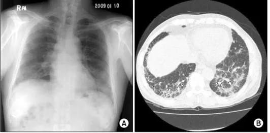 Figure  1.  (A)  Chest  PA  X-ray  shows  diffuse   sub-pleural  haziness  in  both  lung  fields