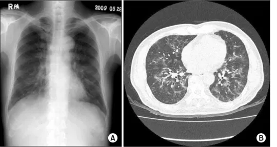Figure  3.  (A)  Chest  X-ray  shows  patchy  nodular  ground  glass  opacity   in-filtrations  in  both  lower  lung  fields