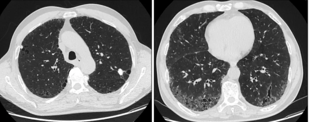 Figure 2. High resolution computed tomography shows peripheral ground-glass attenuation with multiple clustered air-fil- air-fil-led  cysts  in  the  both  lower  lung  zones  and  paraseptal  emphysema  in  both  upper  lung  zones