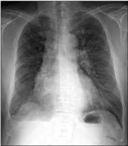 Figure  1.  Chest  radiography.  Mild  emphysema  is  ob- ob-served  in  both  lung  fields