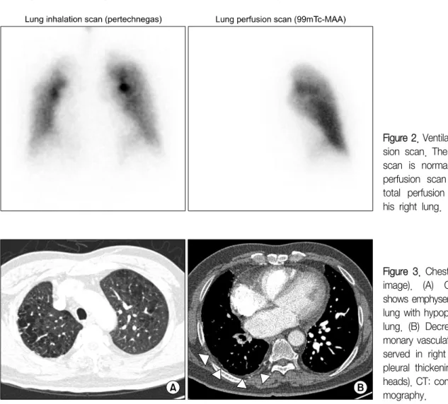 Figure 2. Ventilation/Perfu- Ventilation/Perfu-sion  scan.  The  inhalation  scan  is  normal,  but  the  perfusion  scan  shows  a  total  perfusion  defect  in  his  right  lung.