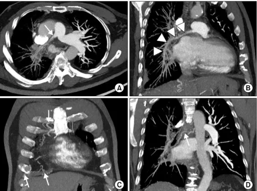 Figure 5. Dynamic MR angiography. In early phase dynamic MR angiography, the right pulmonary artery is not visualized, whereas the entire left pulmonary artery (arrow) is clearly visualized