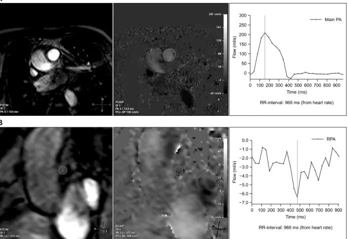 Figure 6. Flow analysis on MRI. (A) Flow in the main PA shows an up-sloping curve above zero, indicating an antegrade flow and a peak velocity of approximately 200 mL/s