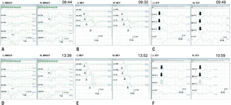 Fig. 2.  Baseline and final data recordings. (A) Baseline median nerve somatosensory evoked potential (MNSEP) show a normal N20 waves (short ar- ar-rows) for each stimulation