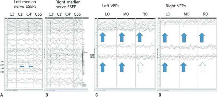Fig. 3.  Stacked results of somatosensory evoked potentials (SSEPs) and visual evoked potentials