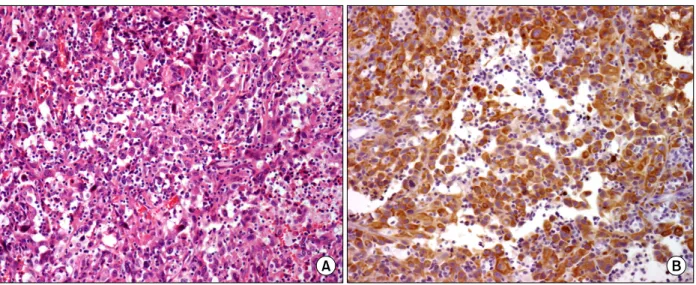 Figure  2.  Cut  surface  of  right  lower  lobe  shows  a  well defined  ovoid  mass  with  central  necrosis.