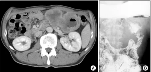 Figure  4.  (A)  Contrast-enhanced  CT  scan  shows  10×6  cm  sized  heterogeneous  enhancing  mass  lesion  in  jejunum without  obstruction  sign