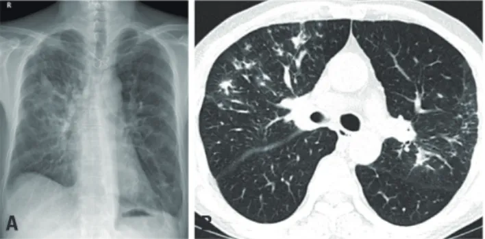 Fig. 1.  Initial chest X-ray (A) and low-dose chest computed tomography  scan (B) showing patch consolidations and diffuse nodules in both  up-per lobes, suggesting active pulmonary tuberculosis.