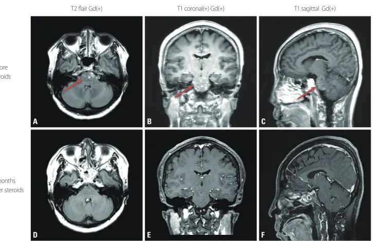 Fig. 1.  FLAIR axial (A, D) and gadolinium-enhanced T1-weighted coronal (B, E) and sagittal (C, F) brain magnetic resonance imaging (MRI)