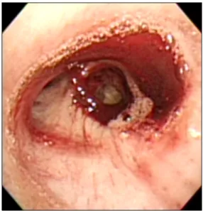 Figure  3.  Bronchoscopic  findings.  The  bleeding  in  the  right  lower  lobe  bronchus  can  be  seen.