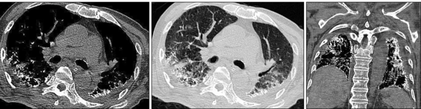 Figure  2.  High-resolution  computed  tomography  revealed  bilateral  pleural  effusions  and  diffusely  distributed  calcified  micronodules.