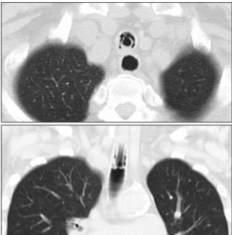 Figure 1. Chest axial and coronal CT images are showing tubular structure with a good patency